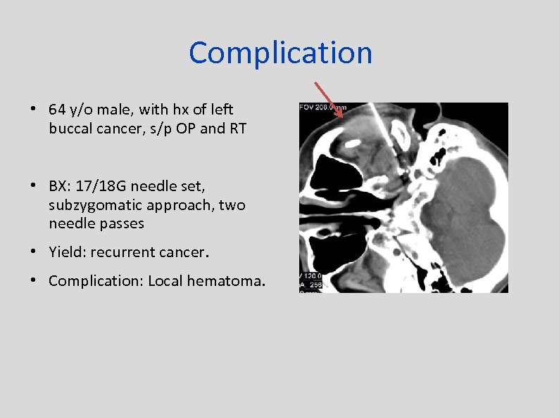 Complication • 64 y/o male, with hx of left buccal cancer, s/p OP and