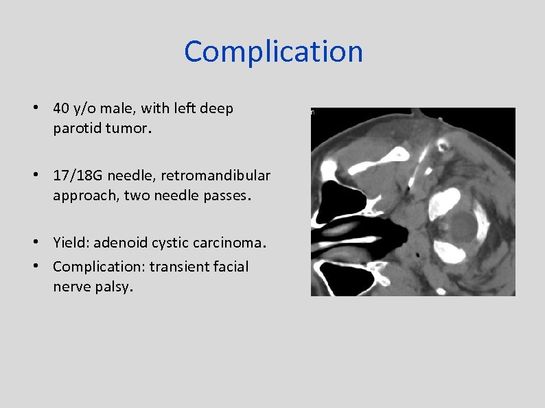 Complication • 40 y/o male, with left deep parotid tumor. • 17/18 G needle,