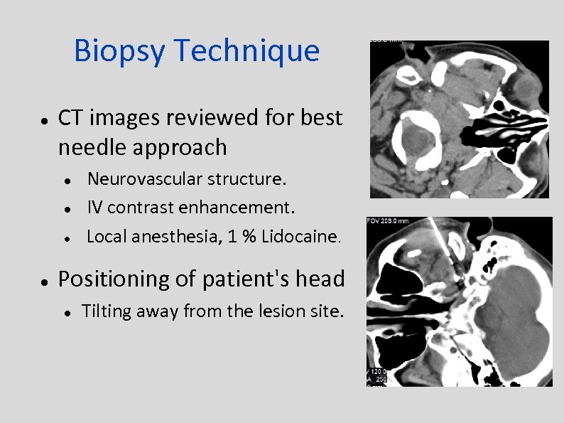 Biopsy Technique CT images reviewed for best needle approach Neurovascular structure. IV contrast enhancement.