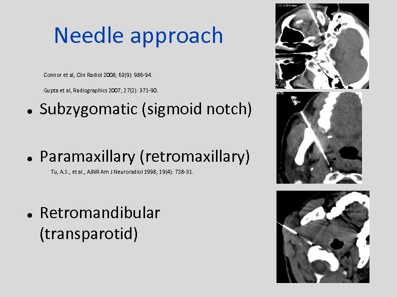 Needle approach Connor et al, Clin Radiol 2008; 63(9): 986 -94. Gupta et al,