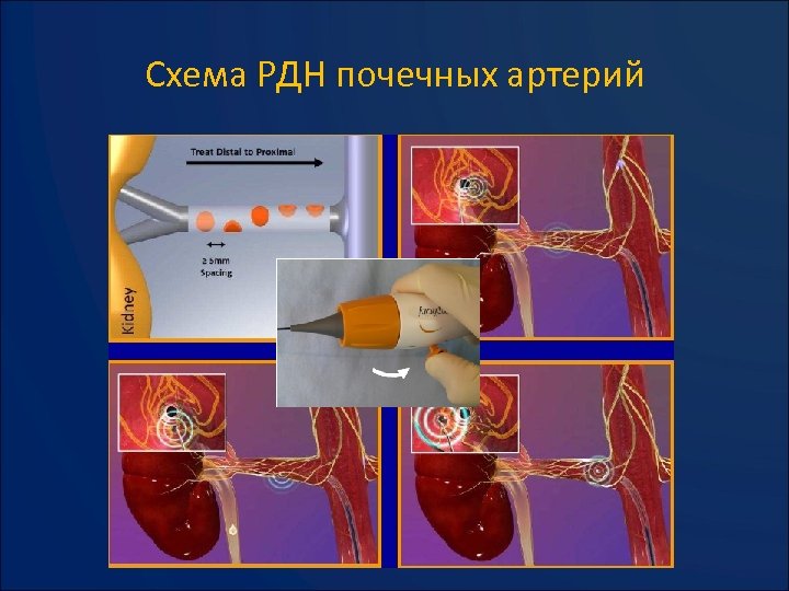 Схема РДН почечных артерий 