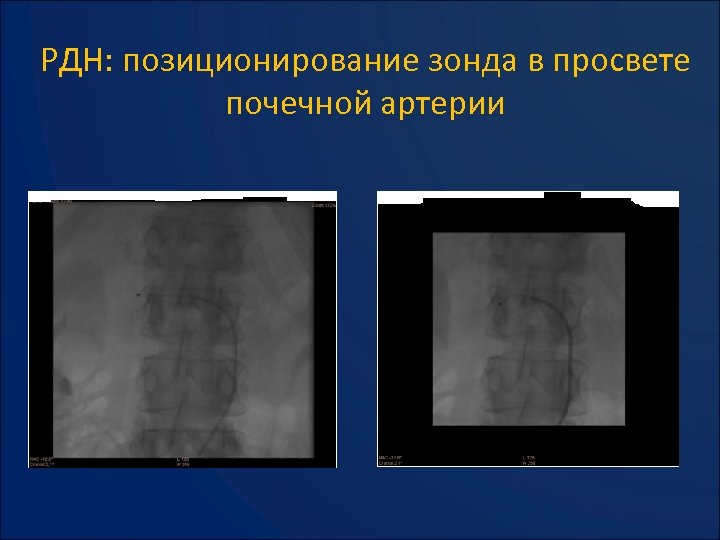 РДН: позиционирование зонда в просвете почечной артерии 