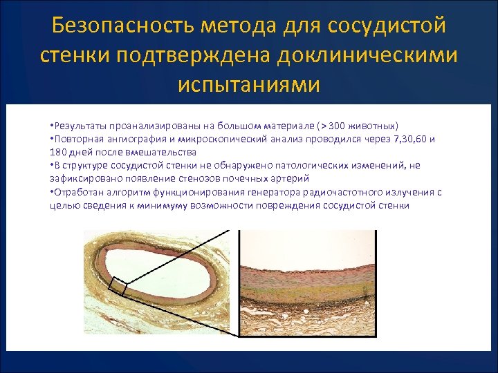 Безопасность метода для сосудистой стенки подтверждена доклиническими испытаниями • Результаты проанализированы на большом материале