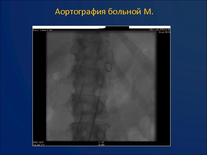 Аортография больной М. 
