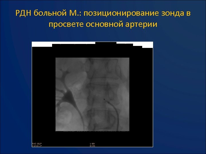 РДН больной М. : позиционирование зонда в просвете основной артерии 