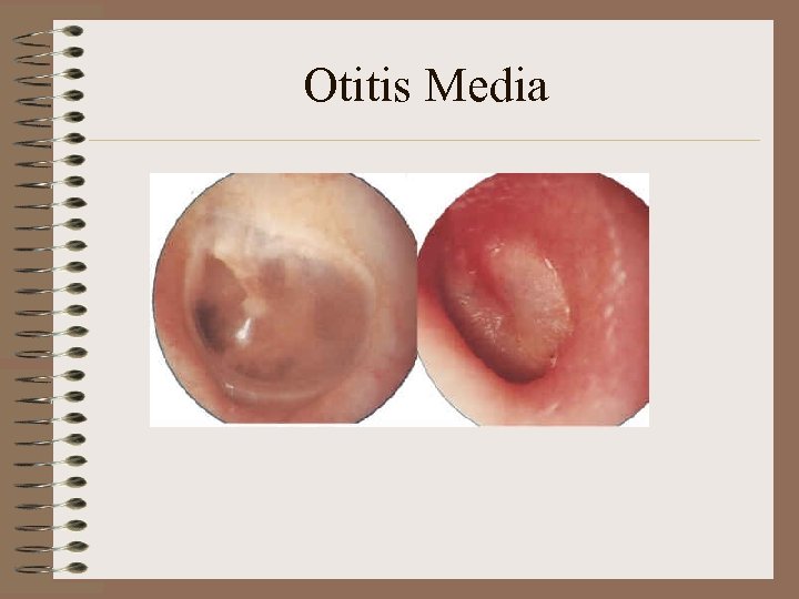 Otitis Media 