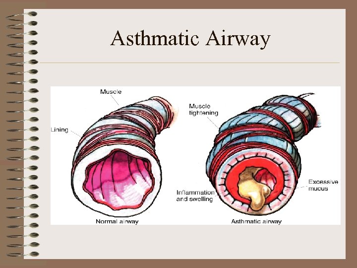Asthmatic Airway 