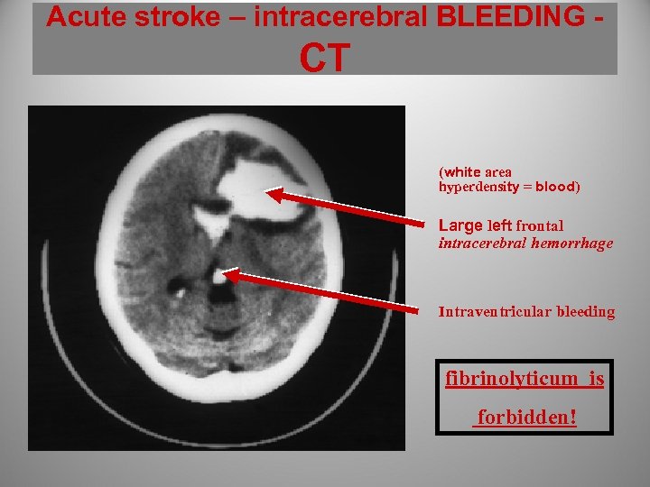 Acute stroke – intracerebral BLEEDING - CT (white area hyperdensity = blood) Large left