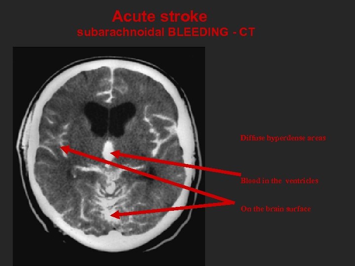 Acute stroke subarachnoidal BLEEDING - CT Diffuse hyperdense areas Blood in the ventricles On