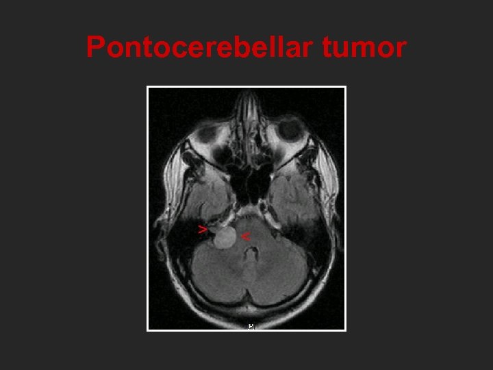 Pontocerebellar tumor 