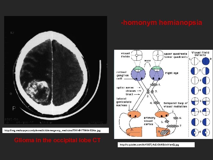 -homonym hemianopsia http: //img. medscape. com/pi/emed/ckb/emergency_medicine/756148 -779664 -324 tn. jpg Glioma in the occipital