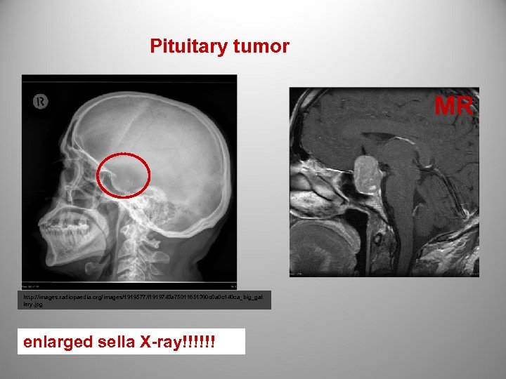 Pituitary tumor MR http: //images. radiopaedia. org/images/1919577/f 1919743 a 75011651390 c 0 a 0