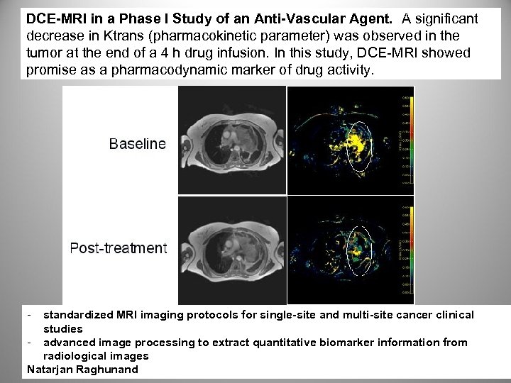 DCE-MRI in a Phase I Study of an Anti-Vascular Agent. A significant decrease in