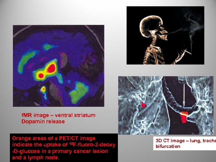 f. MR image – ventral striatum Dopamin release Orange areas of a PET/CT image