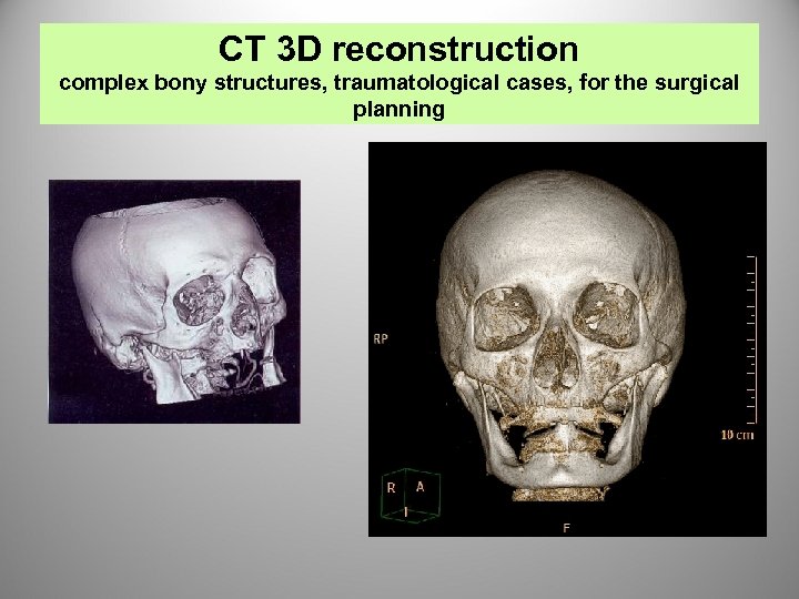 CT 3 D reconstruction complex bony structures, traumatological cases, for the surgical planning 