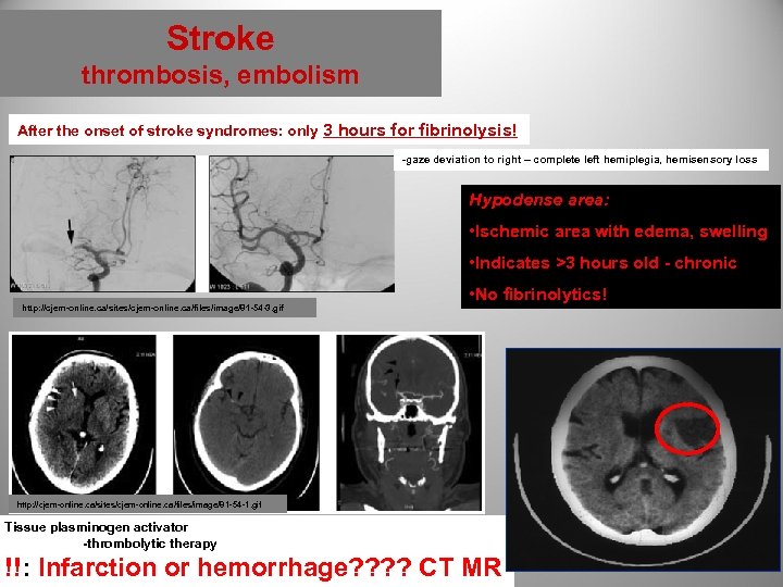 Stroke thrombosis, embolism After the onset of stroke syndromes: only 3 hours for fibrinolysis!