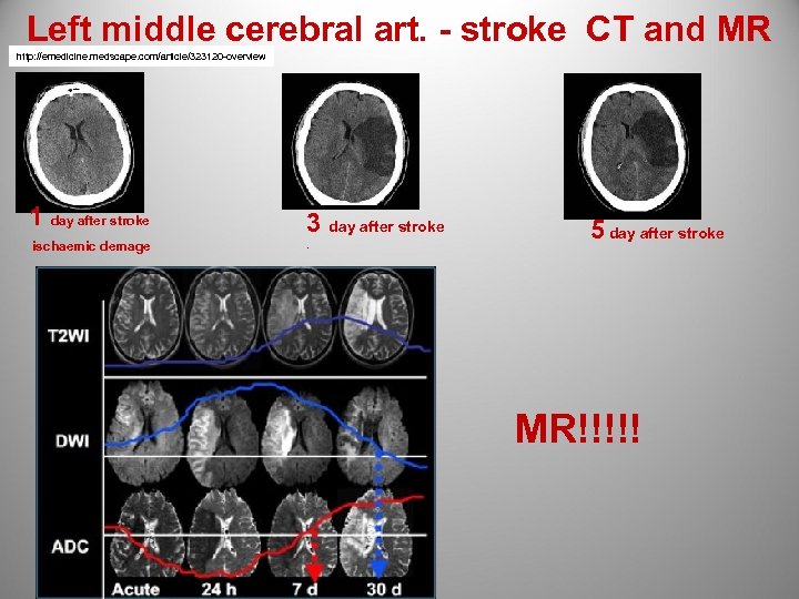 Left middle cerebral art. - stroke CT and MR http: //emedicine. medscape. com/article/323120 -overview