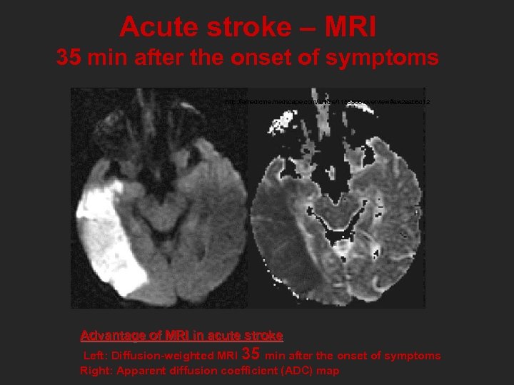 Acute stroke – MRI 35 min after the onset of symptoms http: //emedicine. medscape.