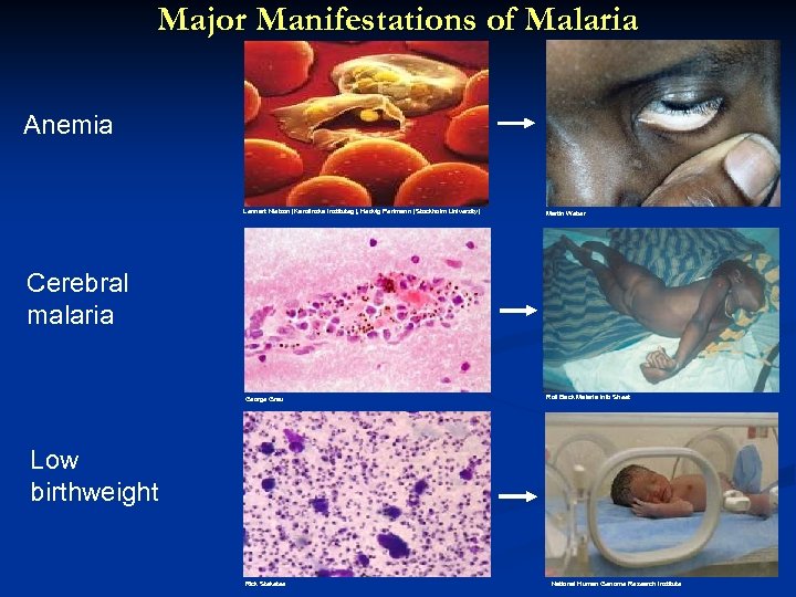 Major Manifestations of Malaria Anemia Lennart Nielson (Karolinska Instituteg), Hedvig Perlmann (Stockholm University) Martin