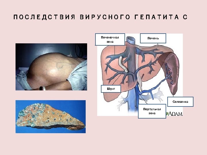 ПОСЛЕДСТВИЯ ВИРУСНОГО ГЕПАТИТА С Печеночная вена Печень Шунт Селезенка Портальная вена 