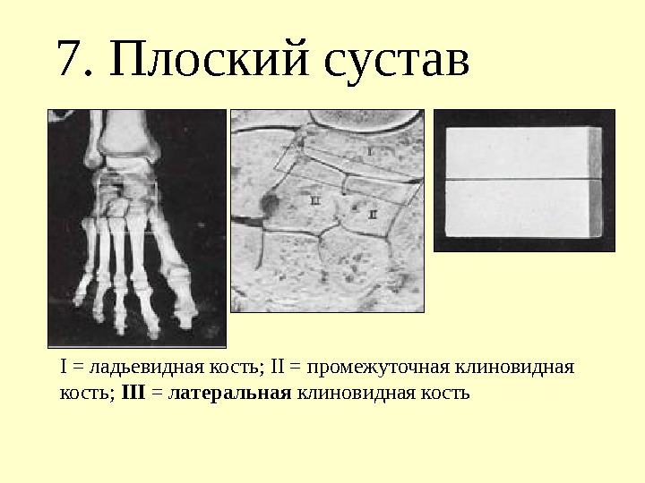 7. Плоский сустав I = ладьевидная кость; II = промежуточная клиновидная кость;  III