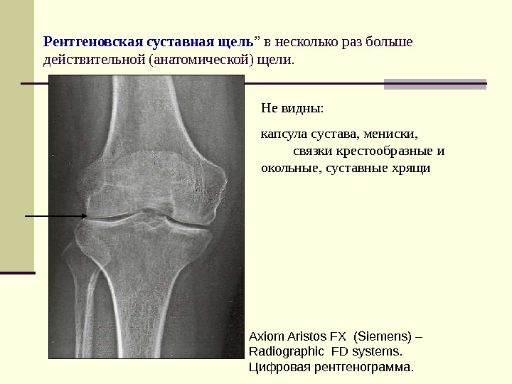 Рентгеновская суставная щель ” в несколько раз больше действительной (анатомической) щели. Axiom Aristos FX