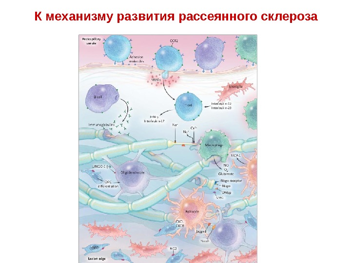К механизму развития рассеянного склероза • Figure 4.  The Multiple Sclerosis Plaque. 