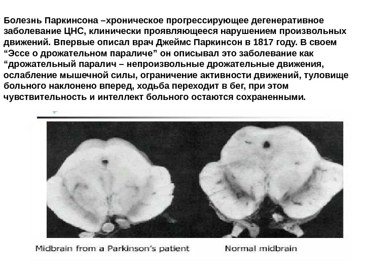   Болезнь Паркинсона –хроническое прогрессирующее дегенеративное заболевание ЦНС, клинически проявляющееся нарушением произвольных движений.
