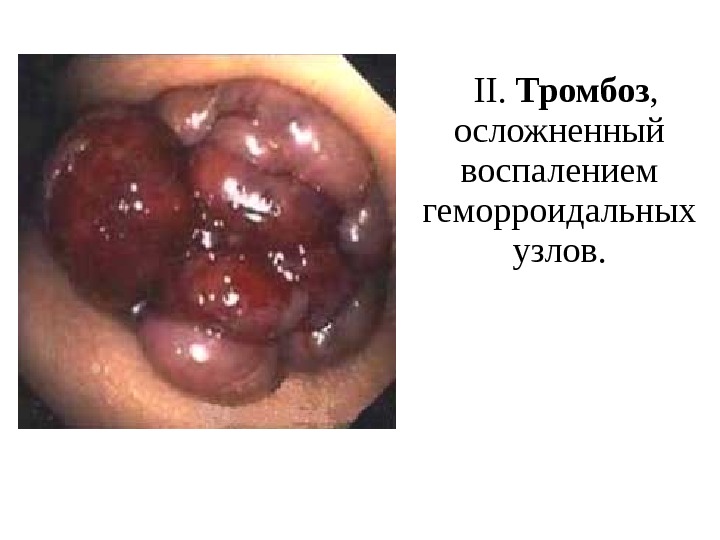  II.  Тромбоз ,  осложненный воспалением геморроидальных узлов. 