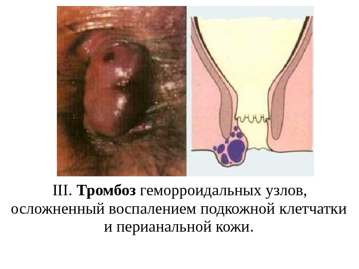  III.  Тромбоз геморроидальных узлов,  осложненный воспалением подкожной клетчатки и перианальной кожи.