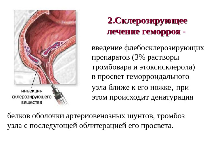 2. Склерозирующее лечение геморроя -  введение флебосклерозирующих препаратов (3 растворы тромбовара и этоксисклерола)