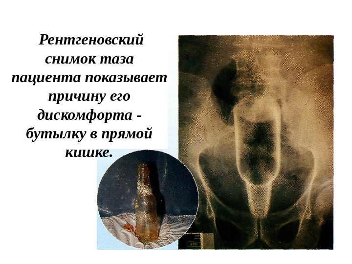  Рентгеновский снимок таза пациента показывает причину его дискомфорта - бутылку в прямой кишке.