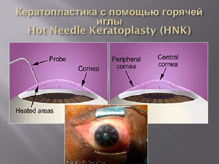 Кератопластика. Кератопластика этапы операции. Кератопластика последствия.