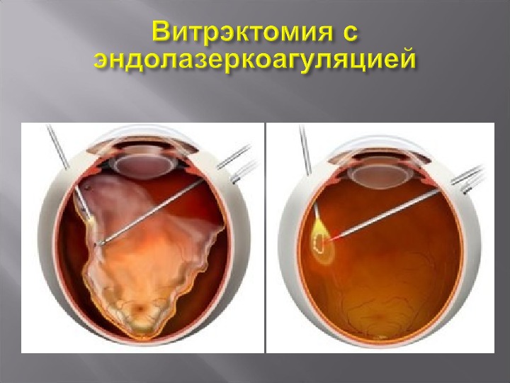 Стекловидное тело операция. Отслойка сетчатки витрэктомия. Витрэктомия ретинопатия. Витрэктомия при диабетической ретинопатии. Витрэктомия сетчатки глаза.