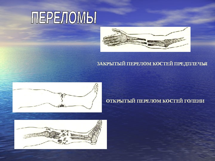 ЗАКРЫТЫЙ ПЕРЕЛОМ КОСТЕЙ ПРЕДПЛЕЧЬЯ ОТКРЫТЫЙ ПЕРЕЛОМ КОСТЕЙ ГОЛЕНИ 