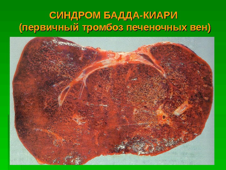   СИНДРОМ БАДДА-КИАРИ (первичный тромбоз печеночных вен)  