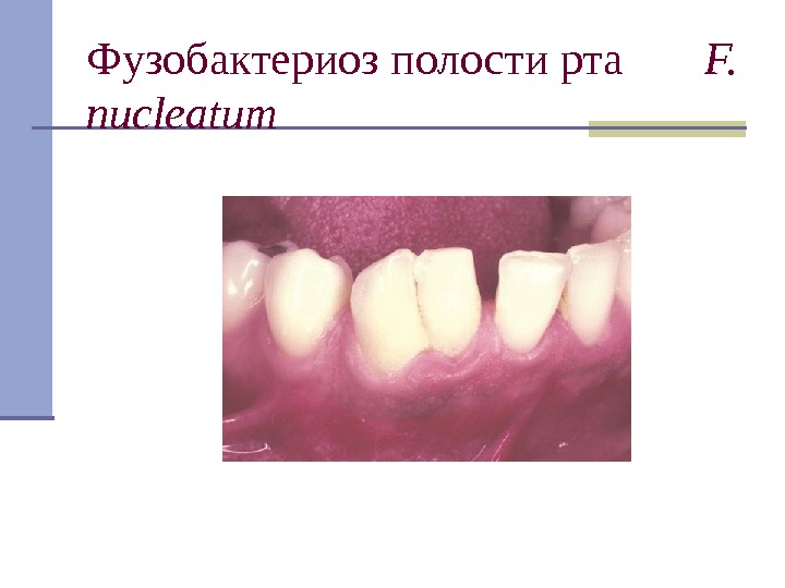 Фузобактериоз полости рта   F.  nucleatum 