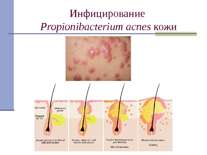 Инфицирование Propionibacterium  acnes  кожи 