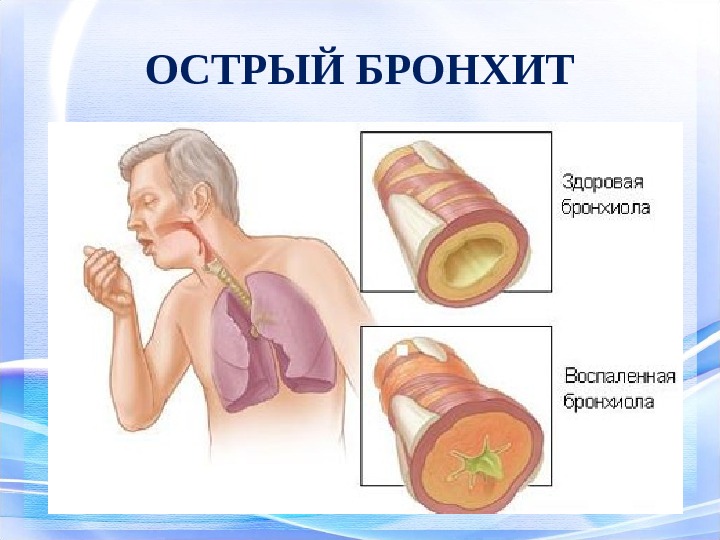 Хронический бронхит презентация