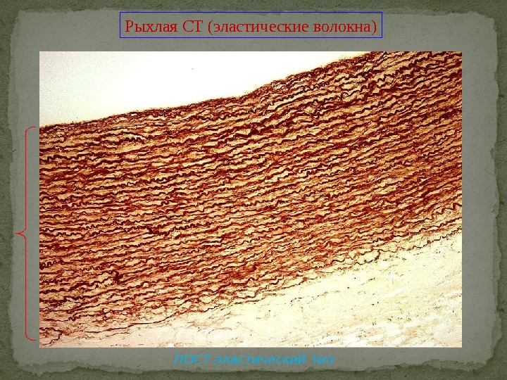 Рыхлая СТ (эластические волокна) ПОСТ-эластический тип 