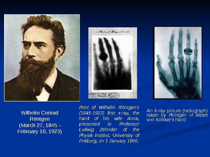   An X-ray picture (radiograph) taken by Röntgen of Albert von Kölliker's hand.