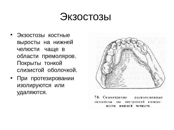 Костная основа полости рта. Экзостозы верхней челюсти. Экзостоз нижней челюсти. Экзостоз альвеолярного отростка. Экзостоз в ротовой полости.