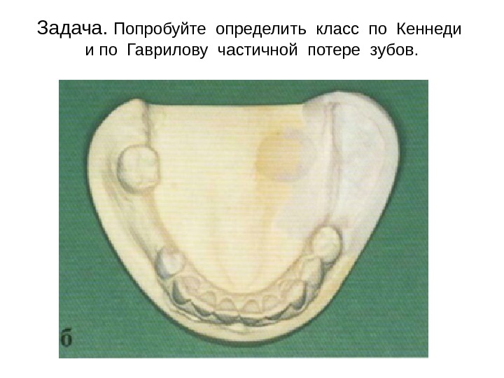 Полость готовиться. Класс потери зубов по Кеннеди. Классы по Гаврилову. Определить класс Кеннеди. Класс Кеннеди стоматология.