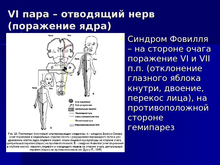 VI VI пара – отводящий нерв (поражение ядра) Синдром Фовилля – на стороне очага