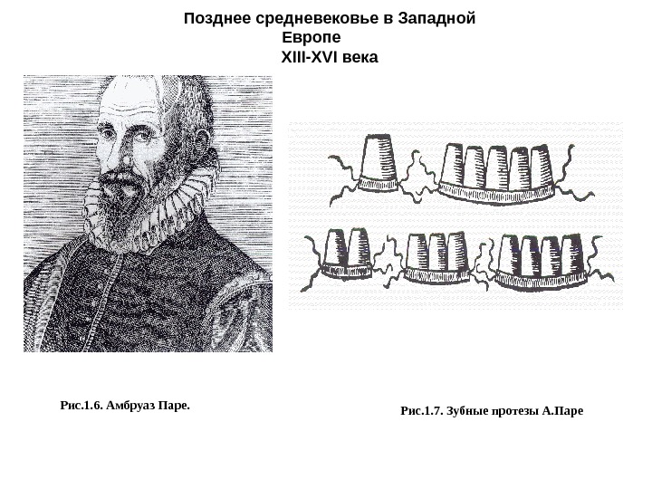 Рис. 1. 7. Зубные протезы А. Паре. Позднее средневековье в Западной Европе XIII -