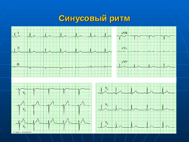   Синусовый ритм 