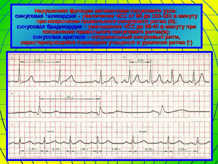   Нарушениях функции автоматизма синусового узла: синусовая тахикардия – увеличение ЧСС от 90