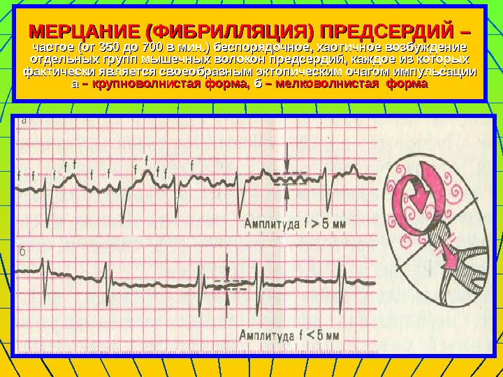   МЕРЦАНИЕ (ФИБРИЛЛЯЦИЯ) ПРЕДСЕРДИЙ – частое (от 350 до 700 в мин. )