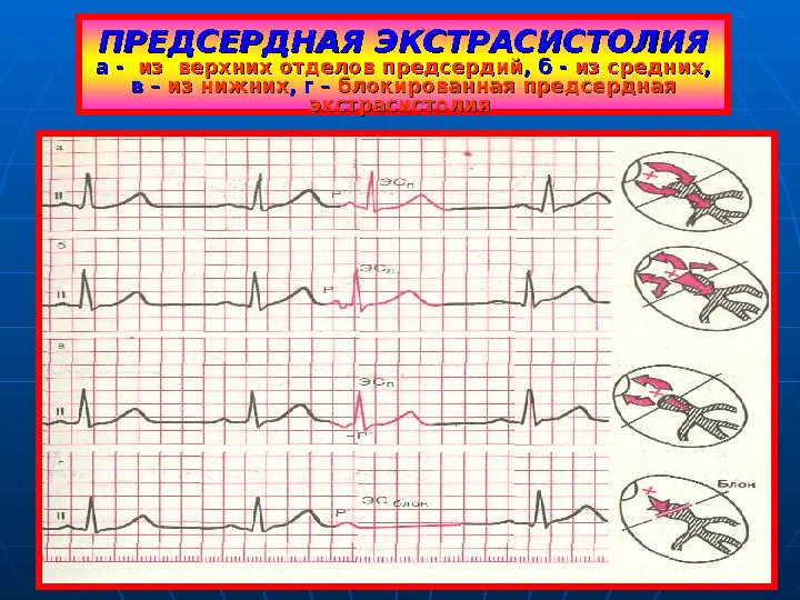 Блокированные экстрасистолы. Экстрасистола предсердия на ЭКГ. ЭКГ при экстрасистолии предсердий. Предсердные экстрасистолы на ЭКГ. Блокированные предсердные экстрасистолы на ЭКГ.