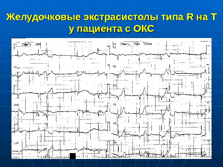 Ранние экстрасистолы